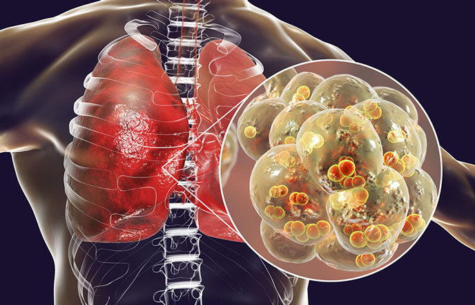 Nguyên nhân bị ap xe phổi do một số chủng nấm