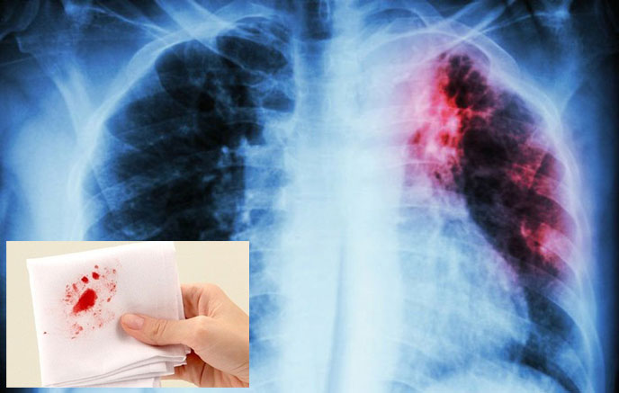 Tình trạng áp xe phổi kéo dài có thể gây ra tình trạng vỡ mạch máu, ho ra máu