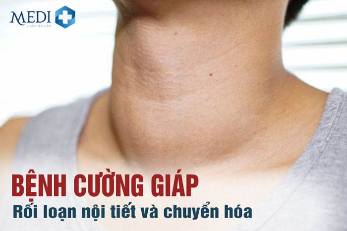 Bệnh cường giáp có chữa khỏi được không? [HỎI ĐÁP]