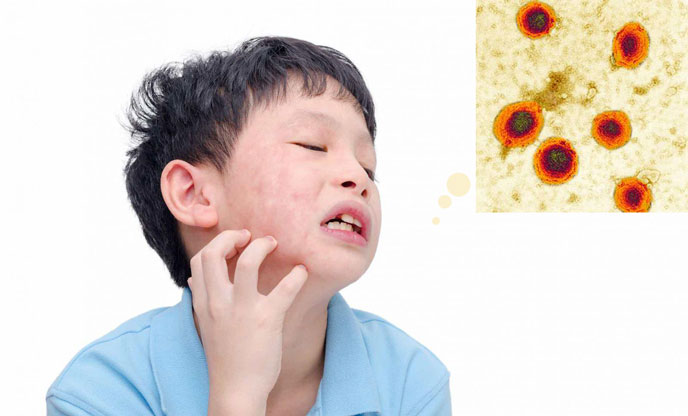 Bệnh quai bị ở trẻ em là một dạng bệnh truyền nhiễm cấp tính