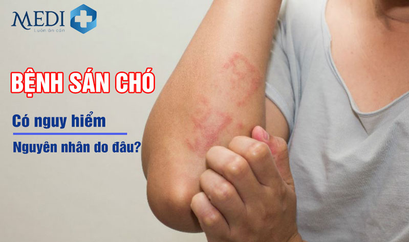 Bệnh sán chó là gì? Có nguy hiểm không, dấu hiệu nhận biết nhiễm sán chó