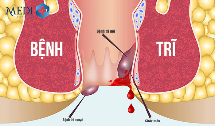 Bệnh trĩ – Biến chứng nguy hiểm và Cách điều trị hiệu quả