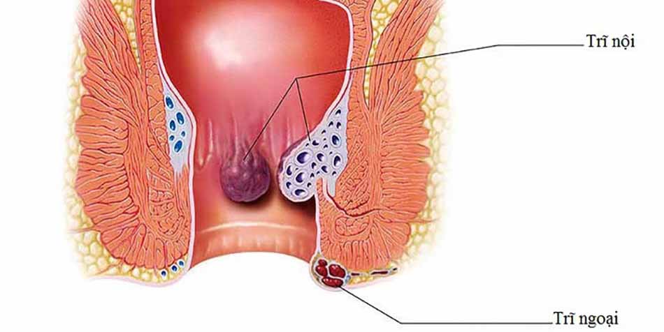 Trĩ hỗn hợp có búi trĩ hình thành ở trong và ngoài ống hậu môn