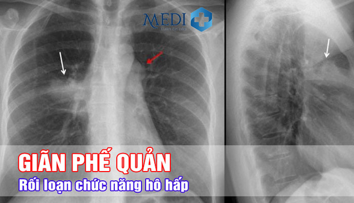 Giãn phế quản biến chứng nguy hiểm gây suy hô hấp, xẹp phổi