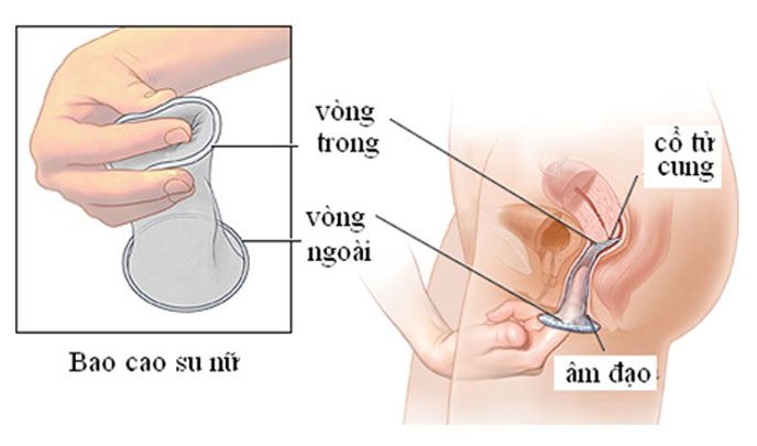 Bao cao su khi được chèn đúng cách sẽ không gây vướng víu và khó chịu cho người dùng