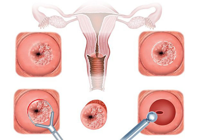 Phương pháp cắt leep lộ tuyến cổ tử cung đồng thời chẩn đoán mắc ung thư cổ tử cung