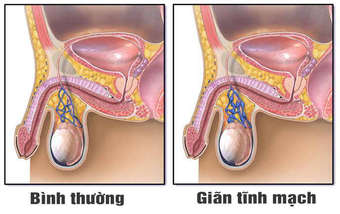 Giãn tĩnh mạch thừng tinh được chẩn đoán bằng cả khám lâm sàng lẫn siêu âm