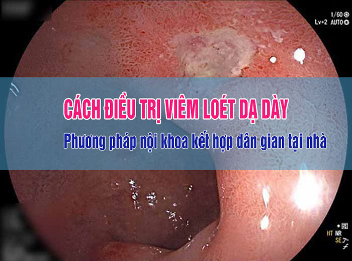 Cách điều trị viêm loét dạ dày nội khoa, phẫu thuật hiệu quả