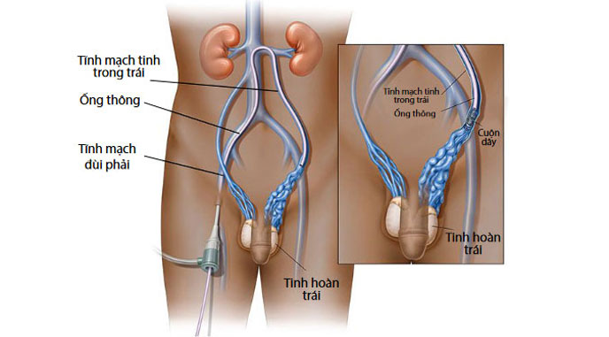 Giãn tĩnh mạch thừng tinh nguyên phát do các khiếm khuyết về van tĩnh mạch