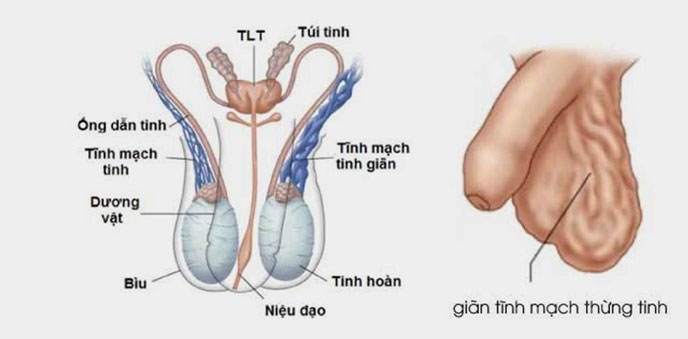 Có khoảng 15% nam giới trưởng thành bị giãn tĩnh mạch thừng tinh