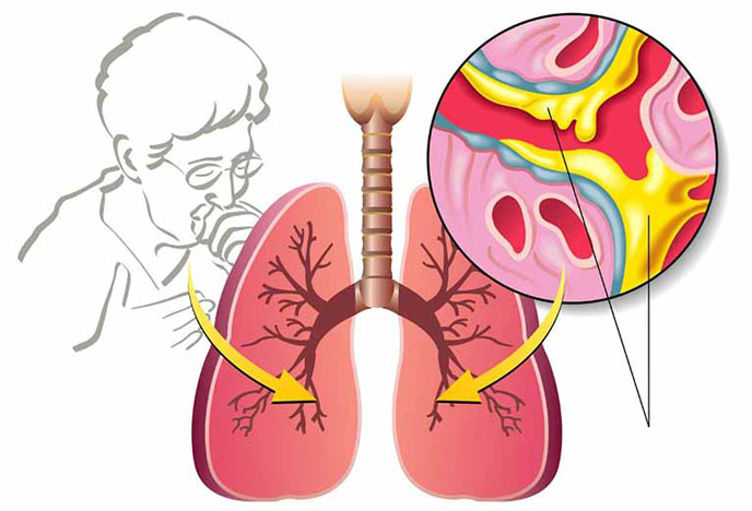 Ho, có đờm là triệu chứng đặc trưng của bệnh giãn phế quản