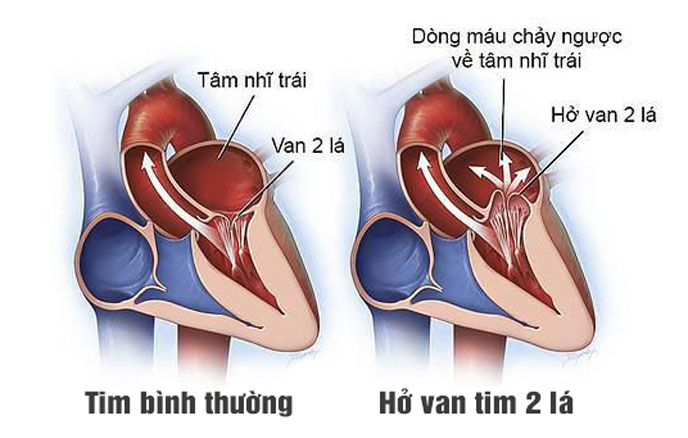 Hở van tim khiến máu chảy ngược lại các tâm thất, tâm nhĩ