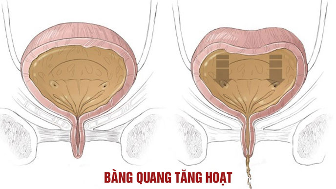 Bàng quang tăng hoạt là một trong những nguyên nhân phổ biến gây tiểu đêm