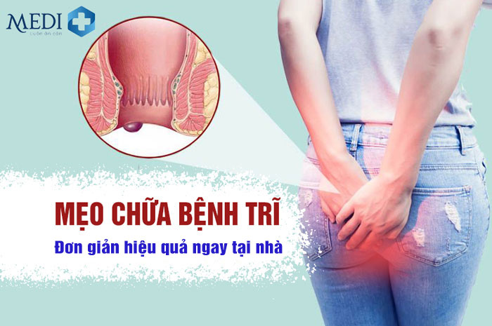 Mẹo chữa bệnh trĩ đơn giản hiệu quả được mọi người chia sẻ