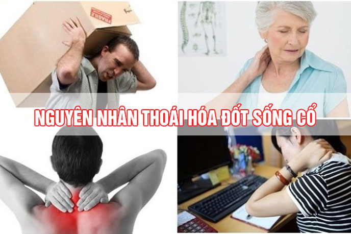 Thoái hóa đốt sống cổ nguyên nhân không chỉ ở người cao tuổi mà đang dần trẻ hóa