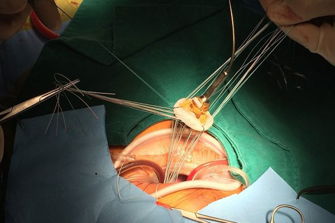 Phẫu thuật thay van tim giúp điều trị triệt để hở van tim