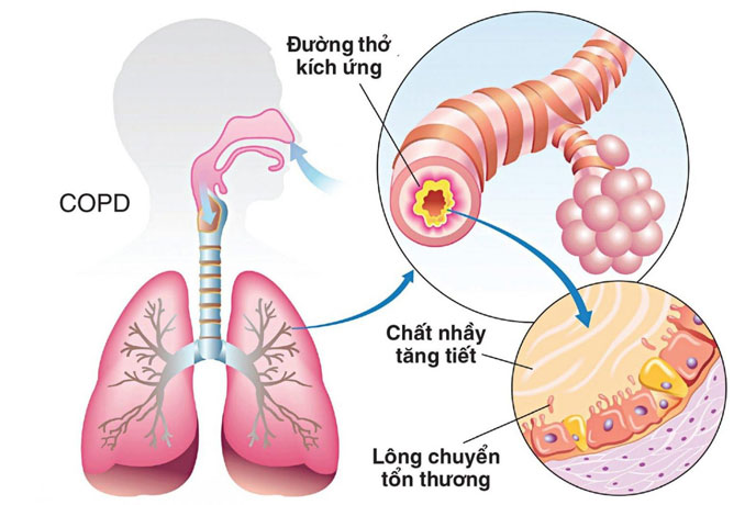 Viêm và tắc nghẽn phế quản kéo dài gây tổn thương cấu trúc thành phế quản