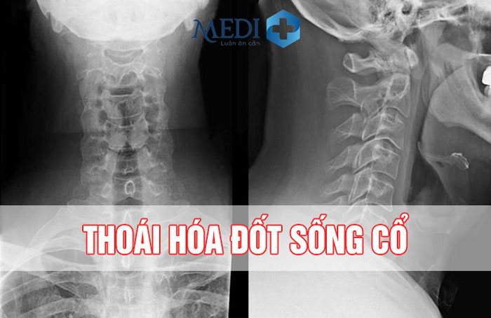 Thoái hóa đốt sống cổ C1 C7: Triệu chứng các cấp độ thoái hóa