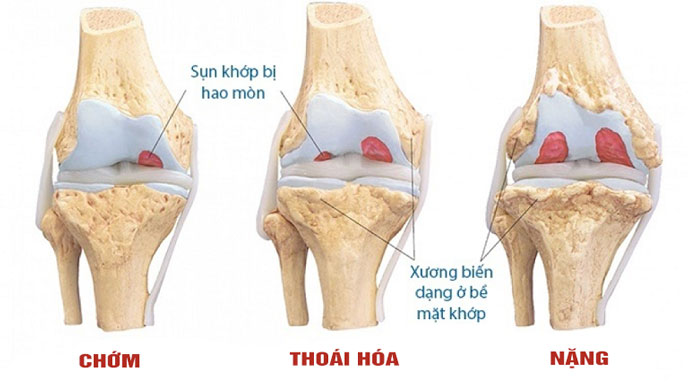 Thoái hóa khớp gối các cấp độ và cách điều trị hiệu quả