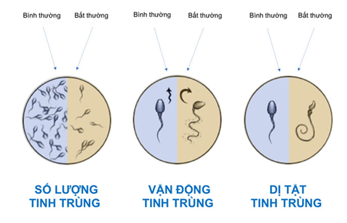 Xét nghiệm tinh dịch đồ đánh giá tình trạng sức khỏe của tinh trùng