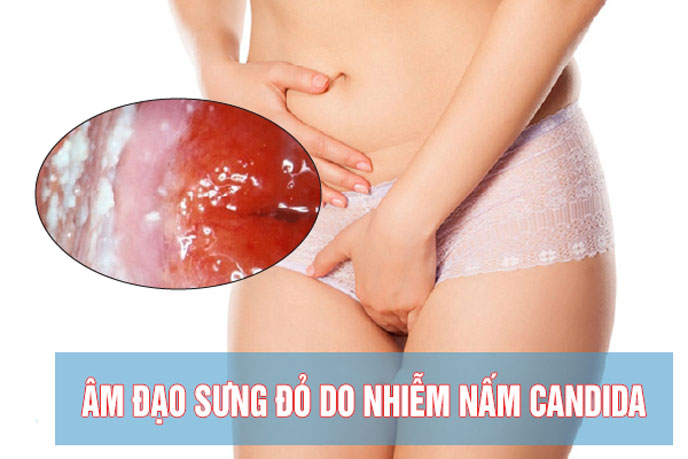 Viêm âm đạo do nấm candida gây sung đỏ đau nhức âm đạo