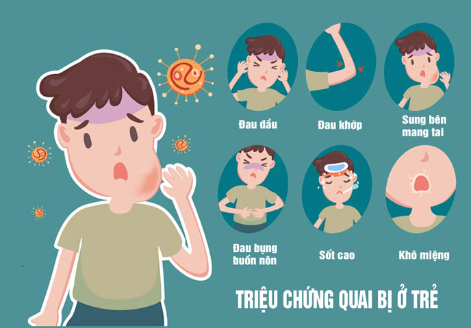 Sốt cao kèm tuyến nước bọt sưng đau là biểu hiện đặc trưng của bệnh