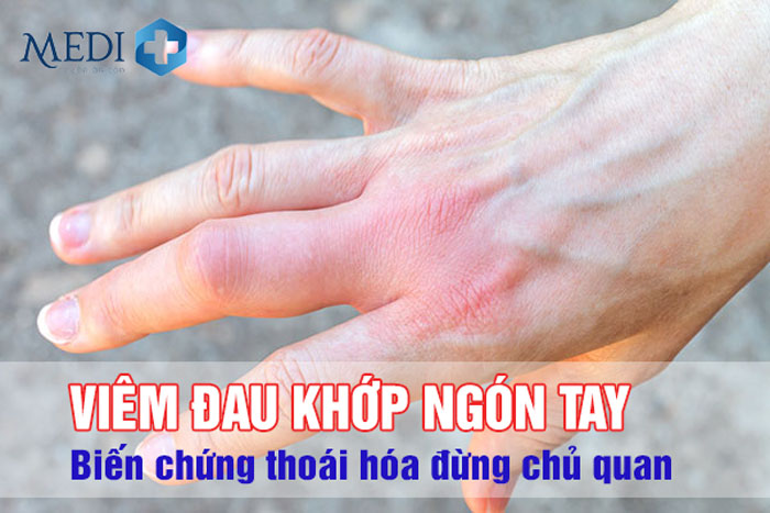 Đau khớp ngón tay: Biến chứng thoái hóa đừng chủ quan