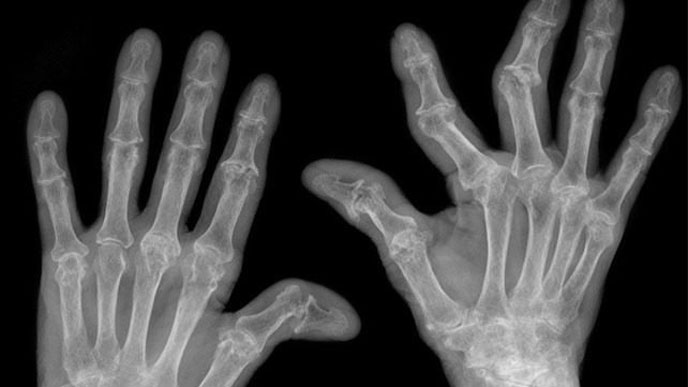 Chụp x quang xác định tình trạng viêm đau khớp ngón tay