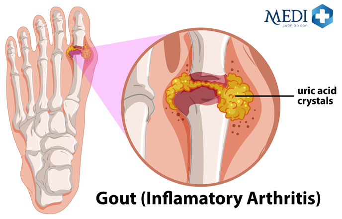 Bệnh Gout do lắng đọng tinh thể urat ở các mô