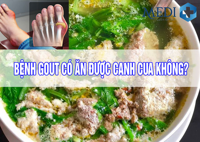 Bệnh Gút (Gout) có ăn được canh cua không? [HỎI ĐÁP]