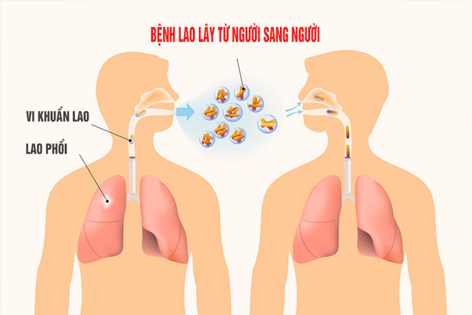 Bệnh lao là bệnh lây truyền qua đường hô hấp nguy cơ lây lan cộng đồng