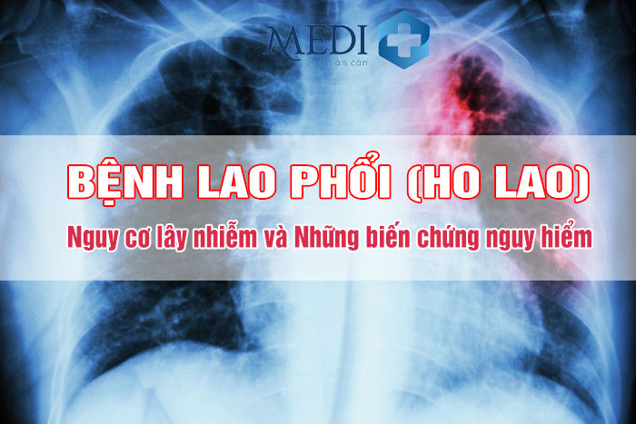 Bệnh lao phổi (ho lao): Dấu hiệu nhận biết và cách điều trị