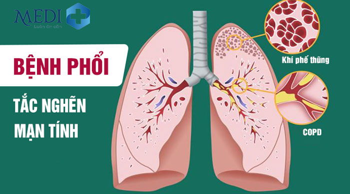 Bệnh phổi tắc nghẽn mạn tính (COPD): Biến chứng nguy hiểm