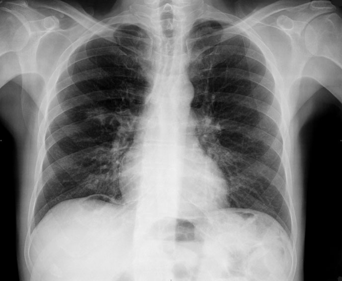 Hình ảnh chụp cắt lớp vi tính phổi bị tổi thương