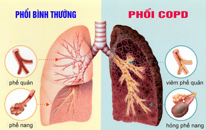 Hình ảnh phổi trước và sau khi tổn thương
