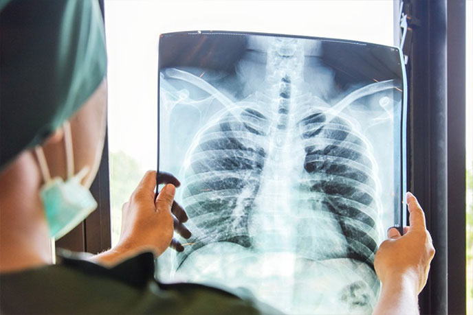 Biến chứng, di chứng của bệnh lao phổi càng nặng khi càng để lâu không được điều trị