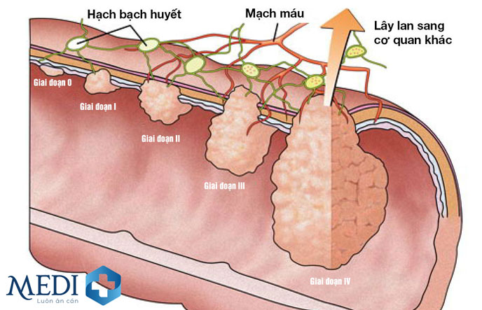 Dựa trên các giai đoạn phát triển của ung thư đại tràng mà các bác sĩ sẽ chỉ định phương pháp điều trị phù hợp.