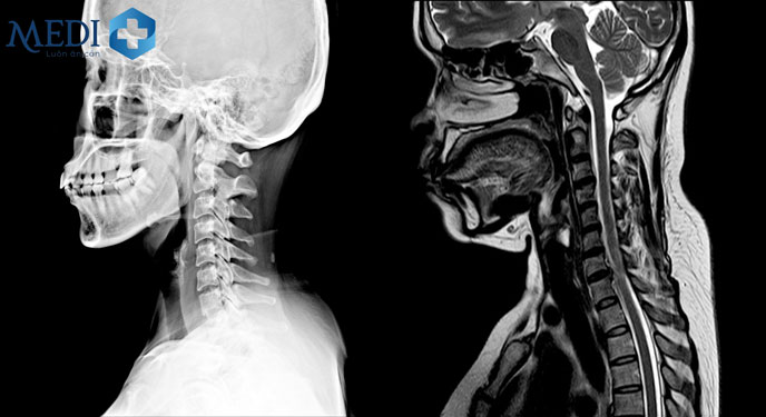 Chụp X quang, MRI cột sống cổ thường được chỉ định để chẩn đoán thoát vị đĩa đệm