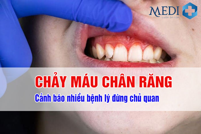 Chảy máu chân răng là bệnh gì? Có phải do thiếu chất hay bị bệnh lý?