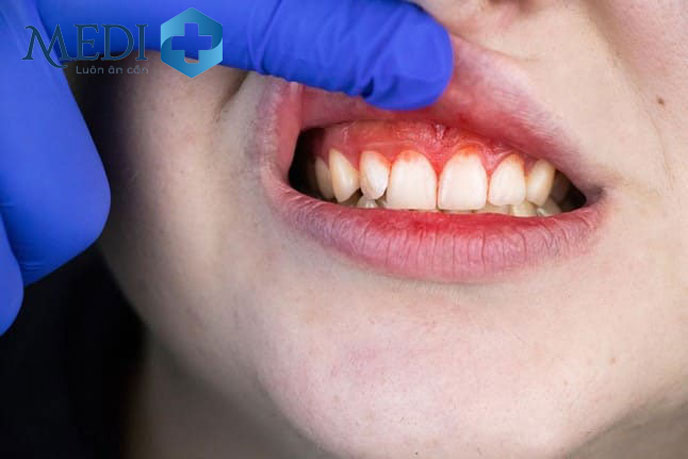 Chảy máu chân răng không đơn giản chỉ là do thiếu chất mà còn cảnh báo nhiều vấn đề khác