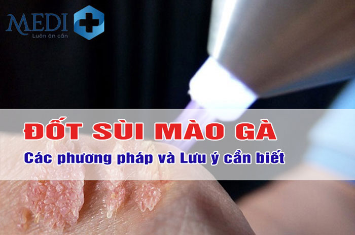 Đốt sùi mào gà: Tất tần tật những điều cần biết khi thực hiện