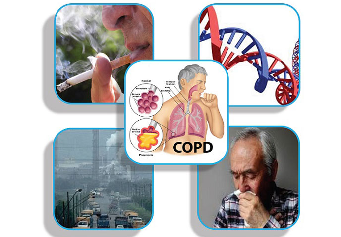 Một số nguyên nhân điển hình gây COPD