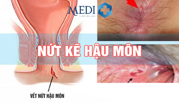 Nứt kẽ hậu môn có nguy hiểm không, điều trị thế nào?