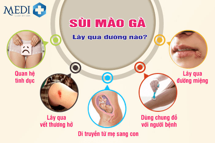 Sùi mào gà lây qua đường nào [Bác sĩ trả lời]