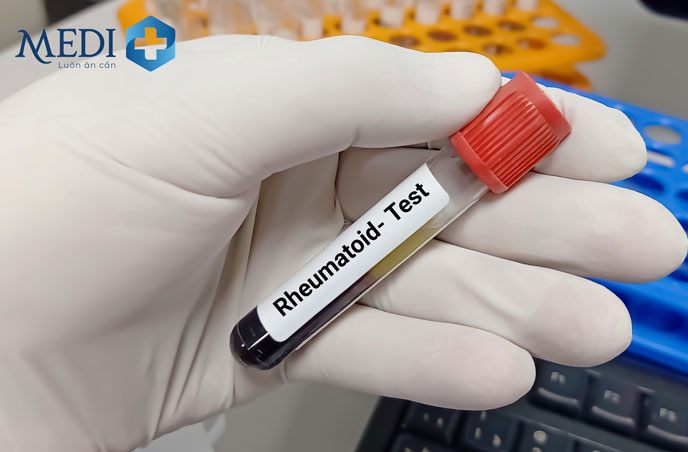 Xét nghiệm yếu tố dạng thấp (RF)  để chẩn đoán bệnh viêm khớp dạng thấp
