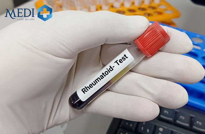 Xét nghiệm yếu tố dạng thấp (RF)  để chẩn đoán bệnh viêm khớp dạng thấp