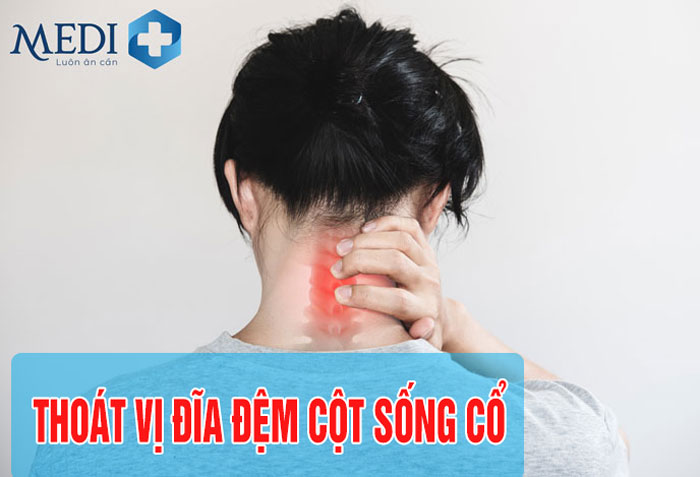 Thoát vị đĩa đệm cột sống cổ, trượt đĩa đệm cách chữa thế nào?