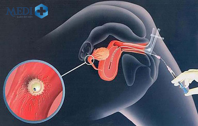 Thụ tinh nhân tạo (Intrauterine Insemination - IUI) phương pháp bơm tinh trùng vào buồng tử cung