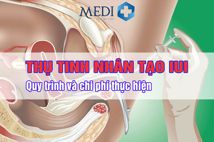 Thụ tinh nhân tạo IUI là gì? Chi phí bao nhiêu tiền, cần lưu ý gì?