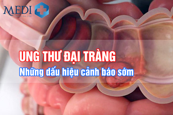 Ung thư đại tràng những triệu chứng bạn cần biết sớm